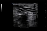 V75_Clinical2